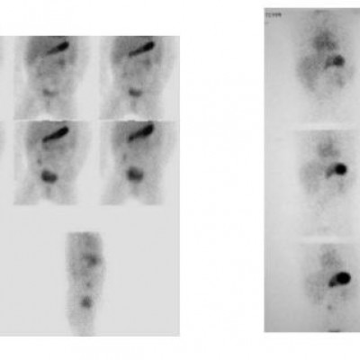 Cintilografia para Pesquisa de Divertículo de Meckel