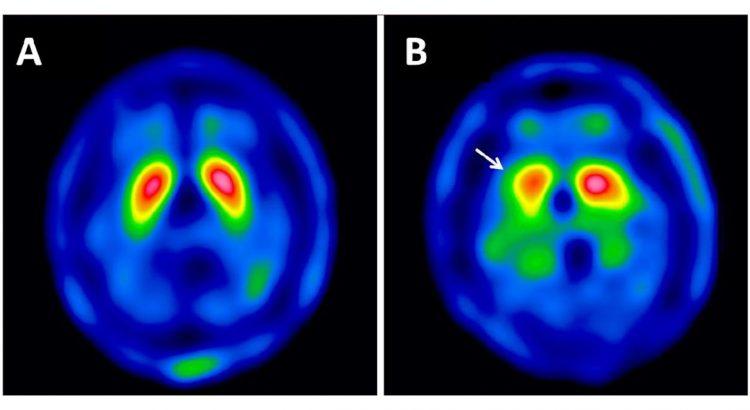 Novo teste é capaz de diagnosticar o Parkinson precocemente - TecMundo